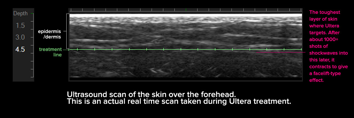 Ultherapy