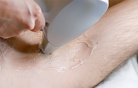 hair_removal