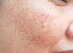 melasma