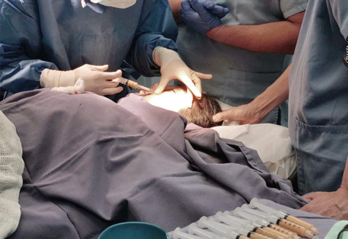 Fat Grafting Procedure